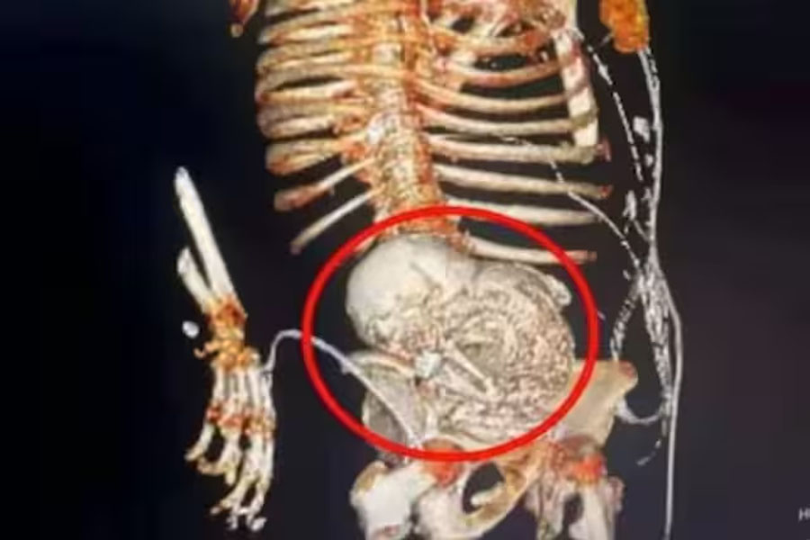 81 years Brazilian woman carried foetus for 56 years