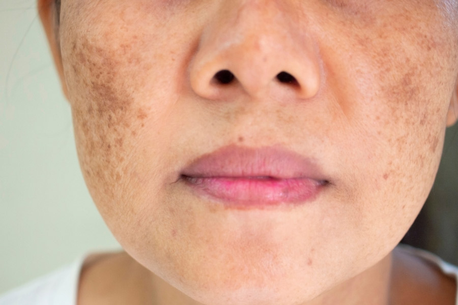 Melasma-Skin-Problem-1