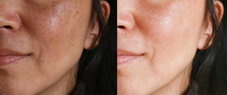 Melasma-Skin-Problem-2