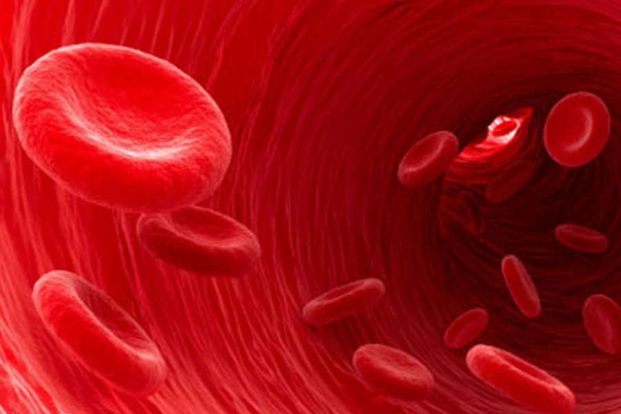 Vasculitis-2