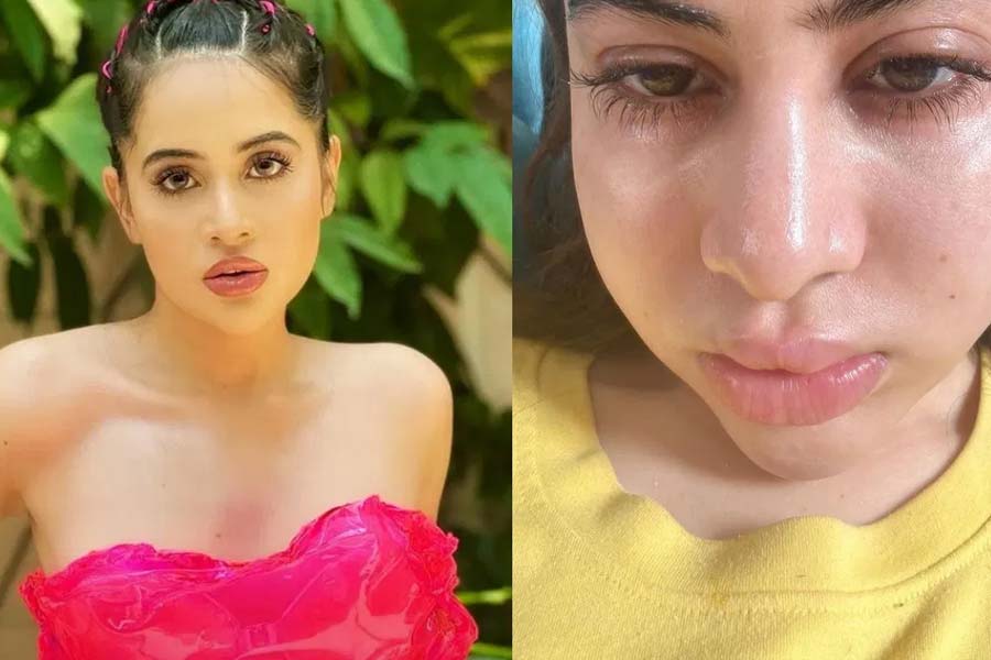 Urfi Javed Shares Photo Of Swollen Face, Claims It's Allergies