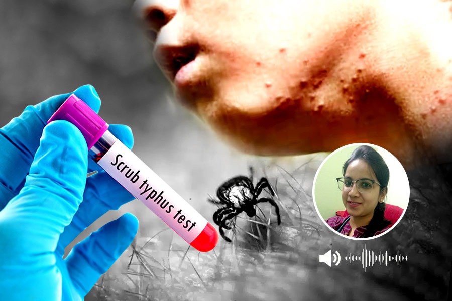 A child has been affected by scrub typhus in Basirhat, What should one do to survive this disease?