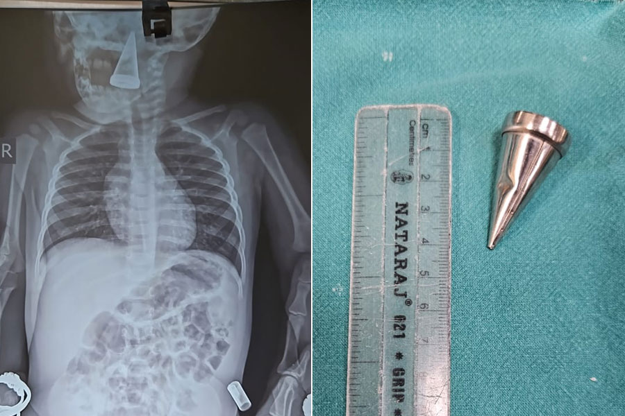 Kolkata Medical College performs rare surgery to remove metal object from baby
