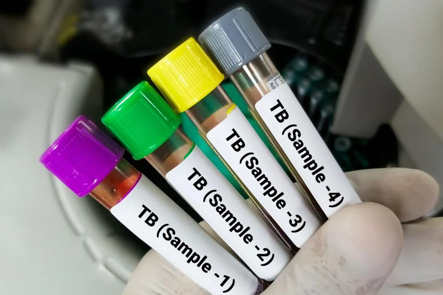 World Health Organisation global report says TB patient decrease rapidly in India
