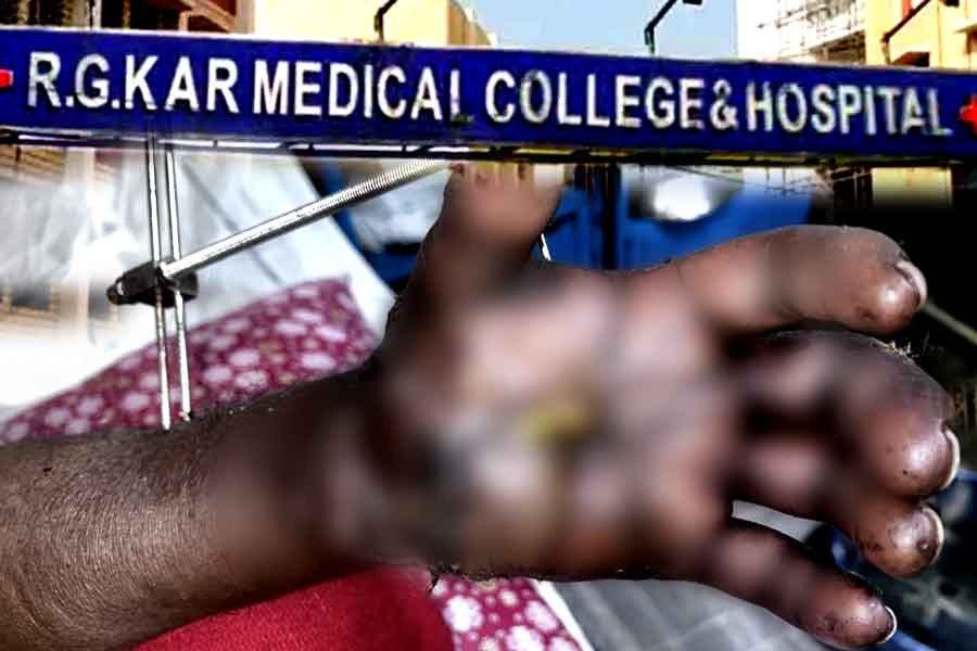 RG Kar Hospital: A Group of Doctors Sets a Record by Saving a Patient Who Survived After His Hand Was Severed