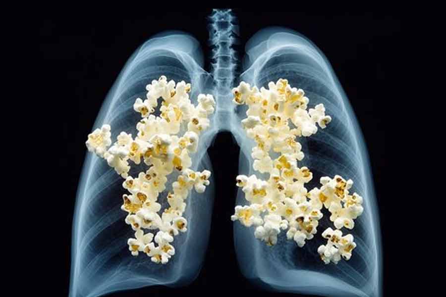 Here are symptoms, causes of Popcorn Lungs