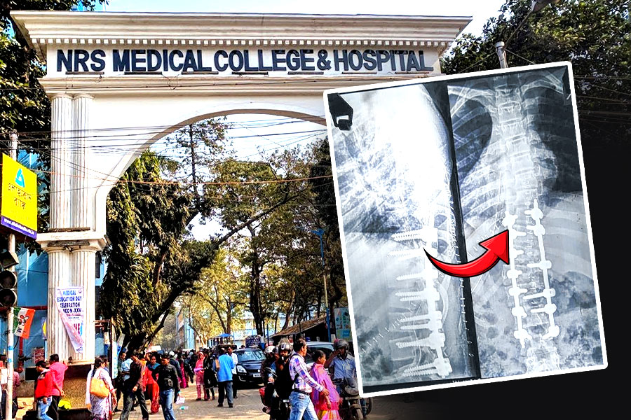 সরকারি হাসপাতালে সফল জটিল অস্ত্রোপচার, ‘ধনুক’ মেরুদণ্ড সোজা করল এনআরএস