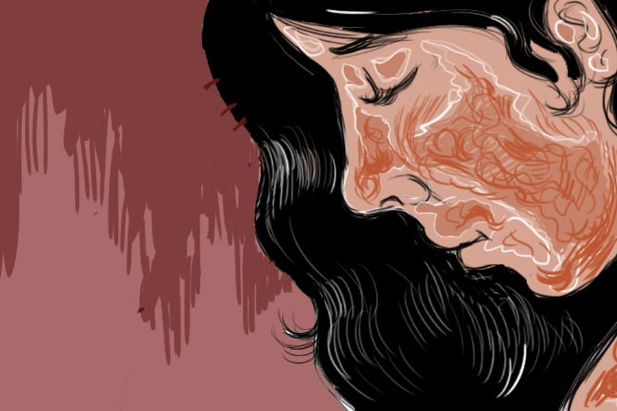 Uttar Pradesh man throws acid at Woman days before her wedding