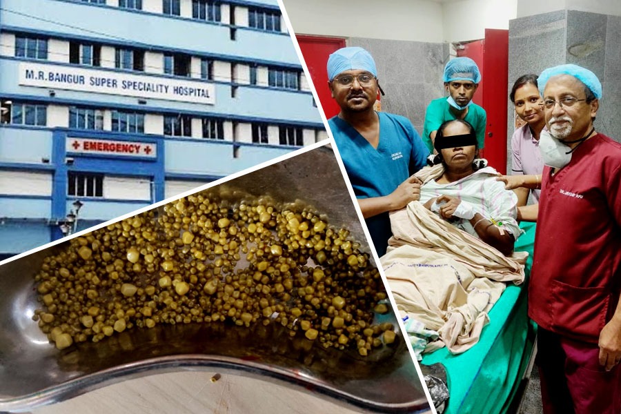 মহিলার পেটে হাজার পাথর! অস্ত্রোপচারে অসাধ্য সাধন এম আর বাঙ্গুরে