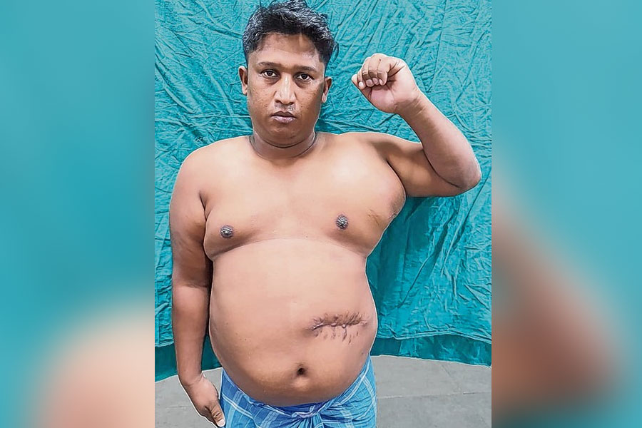 অস্ত্রোপচারের জেরে গভীর ক্ষত! জটিল প্লাস্টিক সার্জারিতে সাফল্য এনআরএসের 