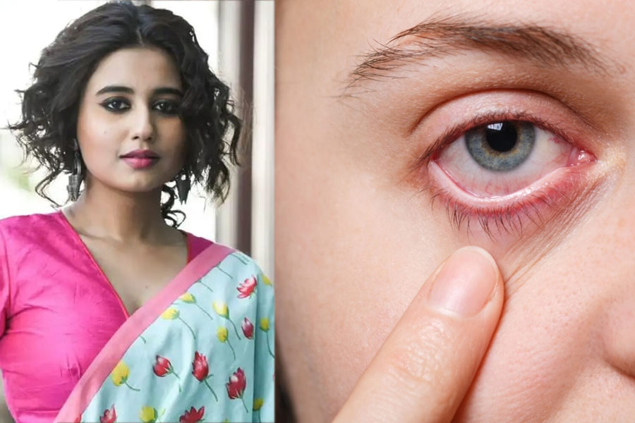 কর্নিয়ায় অসহ্য যন্ত্রণা স্বস্তিকার, কীভাবে ক্ষতিগ্রস্ত হয় চোখের এই অংশ? জানুন চিকিৎসা পদ্ধতি