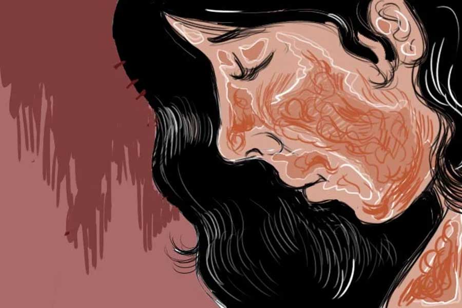বিয়ের প্রস্তাব প্রত্যাখ্যান, জানালার ঘুলঘুলি দিয়ে ছাত্রীকে লক্ষ্য করে অ্যাসিড হামলা! অভিযুক্ত প্রতিবেশী যুবক